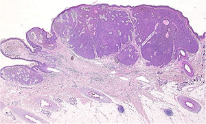 Histopathological examination of the lesion revealed a nodular tumor extending from the epidermis into the mid-dermis (Hematoxylin-eosin stain, original magnification, 20×).