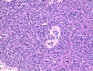 Detail of the histopathological examination: The tumor was composed of small round cells which had a high nucleocytoplasmic ratio, with small pores, which are features of sweat duct differentiations (Hematoxylin-eosin stain, original magnification, 100×).