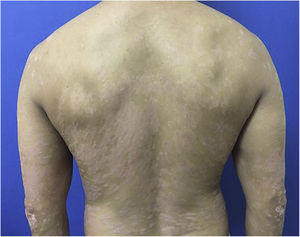 PASI 12.9, erythematous-scaling plaques.