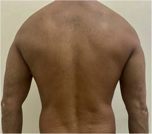 PASI 0, discrete residual macules after 3 years of treatment.