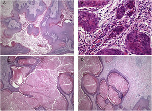 Histopathological features showing neoplastic tissue with an endophytic pattern of growth with abundant keratinization (A). A mixed inflammatory infiltrate composed primarily of lymphocytes and some neutrophils were seen in some areas (B). The endophytic epithelial growth was forming a complex network of connected canaliculi resembling rabbit burrows (C and D). Original magnification was ×10 (A, C and D) and ×40 (B).