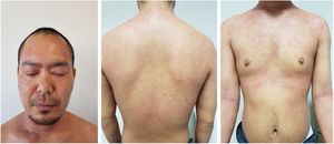Baseline state on one patient in our series (SCORAD 64).