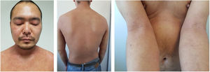 16w after Dupilumab treatment (SCORAD 16).