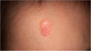 Rounded reddish plaque with warty areas.