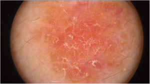 Pinkish-orange lesion with scale formation especially at the perifollicular level without a distinctive melanocytic or vascular pattern.