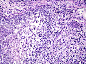Predominantly mononuclear dense inflammatory infiltrates are seen (Hematoxylin & eosin, ×400).