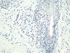 Alcian-blue-positive intercellular material possibly corresponding to mucin deposits. (Alcian blue, ×100).