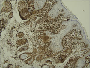 Bcl-2 positive only in the outermost tumor cells; (IMQ, 100×).