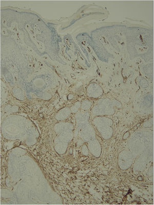 CD-34 positive in stromal tumor cells; (IMQ, 40×).