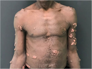 Multiple keloidal nodules disseminated on the skin.