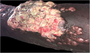 Vegetating, ulcerated, friable plaque located on the anterior portion of the left lower limb, measuring about 12 cm, with the presence of satellite keloidal lesions.
