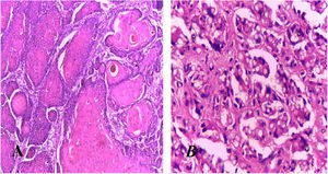 (A), Anatomopathological exam compatible with well-differentiated squamous cell carcinoma (Hematoxylin & eosin, ×40). (B), Dermis adjacent to the neoplastic lesion showing the presence of numerous fungal structures compatible with Lacazia loboi (Hematoxylin & eosin, ×100).