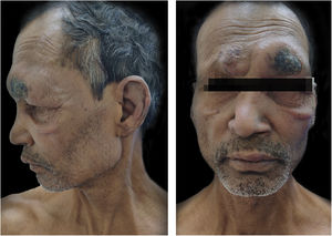 Lepromatous Leprosy with ENL showing lesions before vaccination.