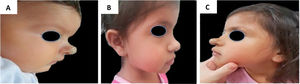 Example of late infantile hemangioma growth 1. (A), Profile of patient with cyrano hemangioma at 2 months of age before treatment. (B), Profile of patient at the end of treatment at 3 years and 2 months of age with propranolol. (C), Profile of the patient at 4 years and 7 months, with late growth.