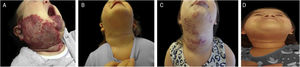 Example of late infantile hemangioma growth. (A), Patient with PHACES syndrome at 2 months of age before treatment. (B), Patient aged 1 year and 10 months – at the end of treatment with propranolol. (C), Patient at 4 years and 6 months of age with late infantile hemangioma growth, when treatment with propranolol was restarted. (D), Patient at 6 years of age, showing regression of the hemangioma.