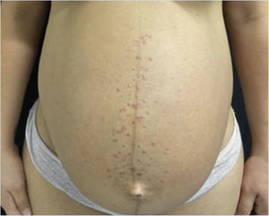 Erythematous papules and pustules located on the sternum and abdomen (linea nigra).