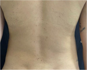 Erythematous papules located on the back.