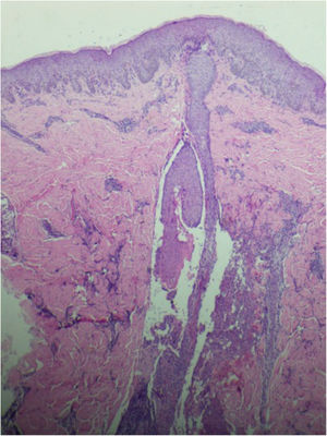 Perivascular infiltrate predominantly consisting of lymphocytes is observed in the dermis (Hematoxylin & eosin, ×40).