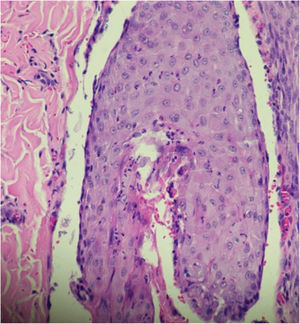 Hair follicle permeated by an inflammatory infiltrate consisting predominantly of neutrophils leading to the destruction of the follicular structure (Hematoxylin & eosin, ×400).