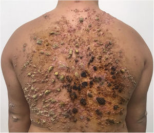 Coalescent papules forming an extensive verrucous plaque on the back, as seen in the first medical consultation.