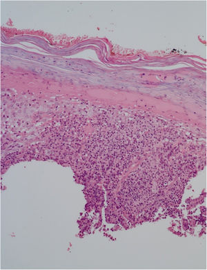 Hyperkeratosis an extensive parakeratosis over a dense lymphohistioplasmocytic inflammatory infiltrate in the dermis, outlining granulomas and numerous neutrophils (Hematoxylin & eosin, ×10).
