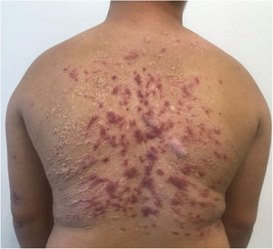 Satisfactory response immediately after treatment with miltefosine.