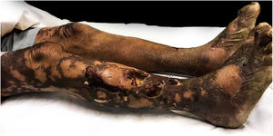 Ulcerated plaques with necrosis and presence of fibrin.