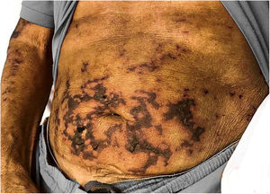 Necrotic areas on the abdomen.