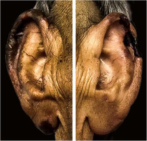 Necrosis on the ear pinnae.