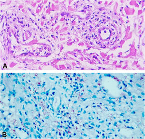 (A), Histological sections showing a neutrophilic infiltrate inside and around the vessels and discrete fibrin deposits (Hematoxylin & eosin, ×400). (B), Numerous acid-fast bacilli (Ziehl-Neelsen, ×400).