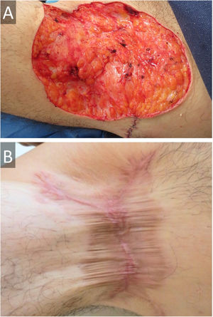 (A), Wide surgical excision of hidradenitis suppurativa on right axilla, with approximation of borders and (B), secondary intention healing with calcium alginate followed by hydrocolloid dressings at 36 weeks, with certain retraction, but no functional impairment.