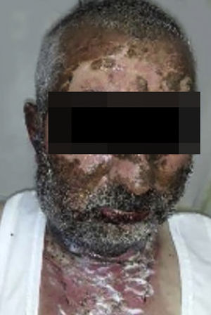 Diffuse epidermal detachment was seen on face.