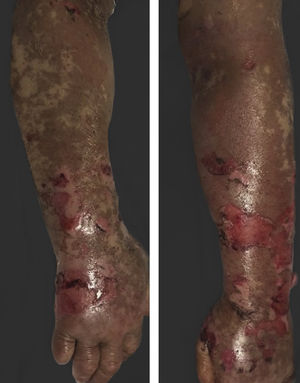 Diffuse epidermal detachment was seen on arms.