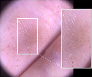 Fine round-to-ovoid comedo-like central depression areas surrounded by white halo-like scales and white linear scales connecting the whole structure.