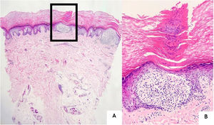 (A), Two “ball and claw” appearances in the middle and right side of the photo (Hematoxylin & eosin, ×40). (B), Epidermal collarette surrounding the dermal lymphohistiocytic infiltrate and a parakeratotic focus located right above it (Hematoxylin & eosin, ×200).