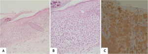 (A), Spongiotic epidermis with foci of basal hydropic degeneration; superficial dermis with moderate diffuse band-like inflammatory infiltrate (Hematoxylin & eosin, ×100). (B), Cells with an oval nucleus, focally lobulated, in addition to mature lymphocytes and some eosinophils (Hematoxylin & eosin, ×200). (C), Diffuse positivity for CD1A (×200).
