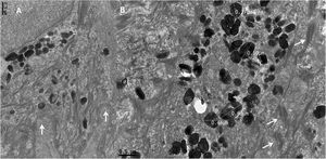Transmission electron microscopy (A), basal keratinocyte with hemidesmosomes and normal basement membrane (arrows) (×30,000). (B), Large amount of heterogen melanosomes with normal size and normal desmossomes (arrows) (×30,000).