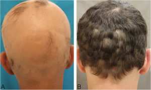 (A), At start of treatment; (B), after 24 weeks of DPCP treatment.
