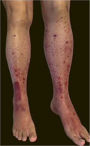 Purpuric lesions on the lower limbs on the first day of hospitalization.