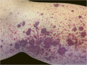 Multiple petechiae and palpable purpura.