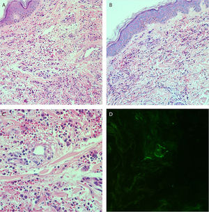 (A and B), Histopathology of the skin showing diffuse inflammatory infiltrate in the dermis (Hematoxylin & eosin, ×100). (C), Postcapillary dermal vessels permeated by neutrophils with leukocytoclasia. Presence of signs of endothelial damage with mural and interstitial fibrin deposits, in addition to extravasated red blood cells. (Hematoxylin & eosin, ×400). (D), Direct immunofluorescence showing granular deposits of IgA and IgM on the postcapillary vessel wall.