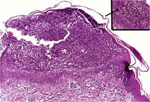 Pustular psoriasis: subcorneal pustule, of the spongiform type (inset, arrow). Hematoxylin & eosin, ×100 and ×400 (inset).