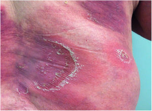 Eruptive presentation of generalized pustular psoriasis.