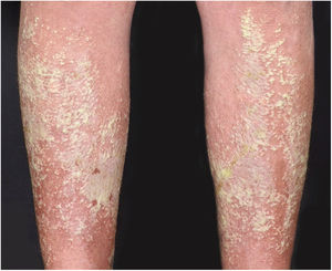 Generalized presentation affecting the lower limbs.