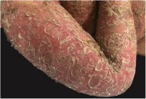 Severe condition affecting the upper limbs.