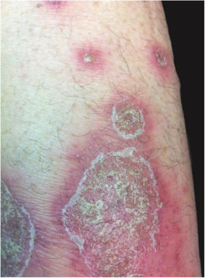 Pustular eruption over plaques of psoriasis vulgaris.