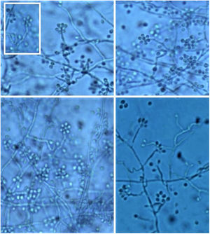 Microscopy of culture (filamentous form 25 °C) – Thin, hyaline hyphae with conidiophores implanted at 90° from the hyphae and terminal phialides in a characteristic floral arrangement or “daisy-like” shape.