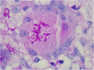 Histopathological examination of the skin of a patient with the disseminated form. “Cigar-shaped” yeast cells (PAS, ×400).