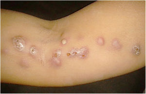 Cutaneous lymphatic sporotrichosis. Nodules draining seropurulent secretion, papules and pustules on the right upper limb along the ipsilateral lymphatic chain.
