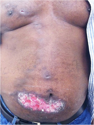 Cutaneous lymphatic sporotrichosis – aggressive presentation. Extensive ulceration in the lower abdomen and nodules along the lymphatic chain of the anterior trunk.